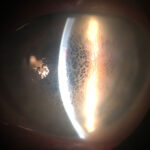 What Is Honeycomb Corneal Edema?