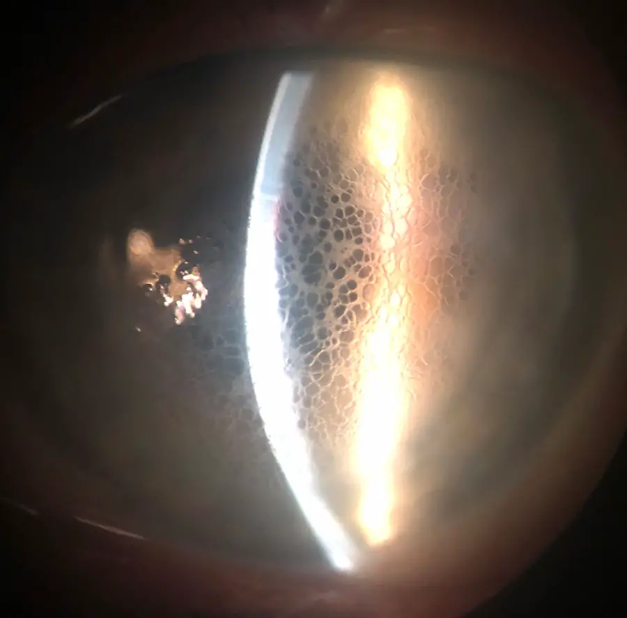 What Is Honeycomb Corneal Edema?