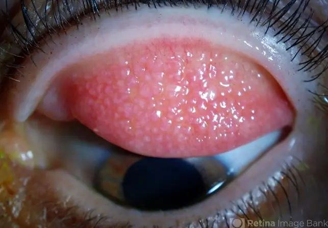 Understanding Giant Papillary Conjunctivitis 2 Understanding Giant Papillary Conjunctivitis