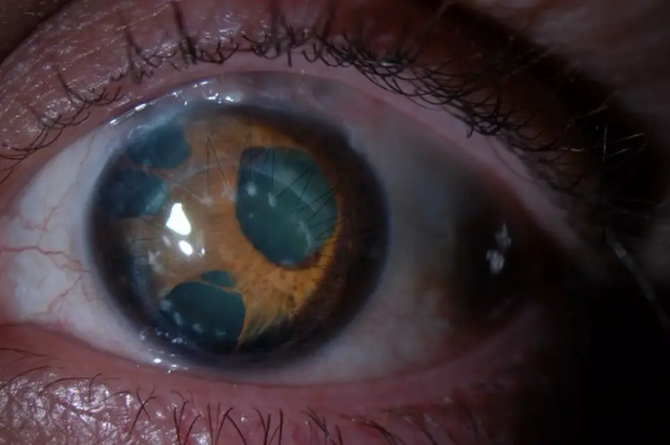Iridocorneal Endothelial (ICE) Syndrome: A Practical Guide for Optometrists 2 69c9f06b 3101 4d17 916d baa85ed44f8e