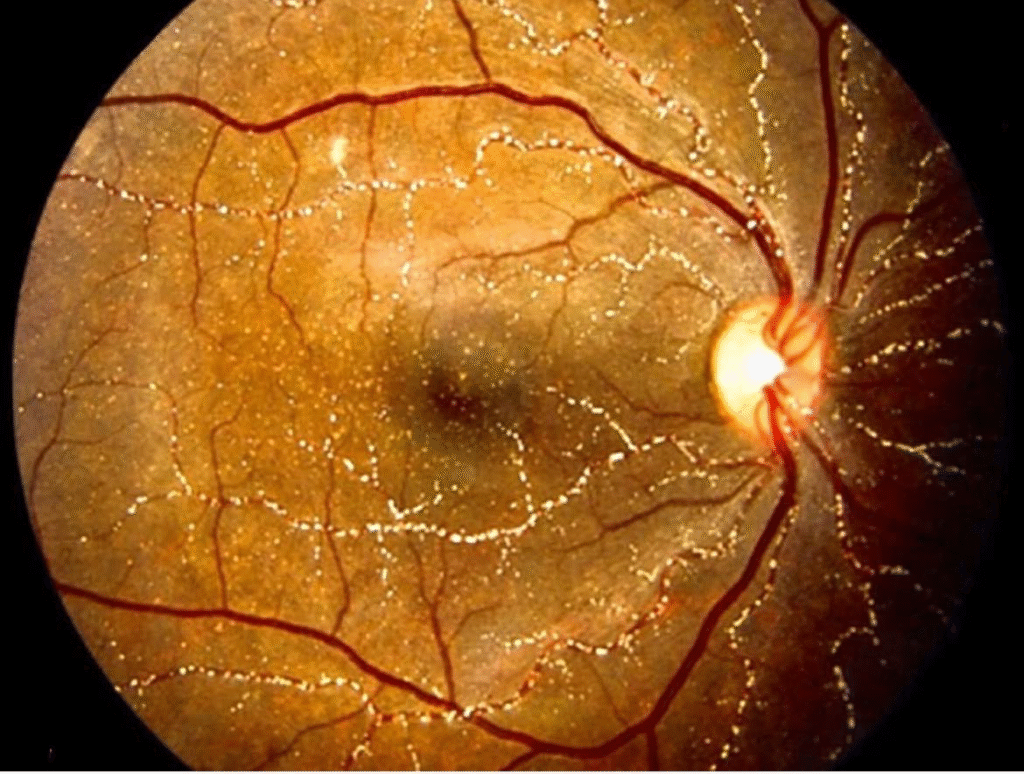 Methoxyflurane-Induced Crystalline Retinopathy: A Rare Toxic Retinal Disorder 2 image