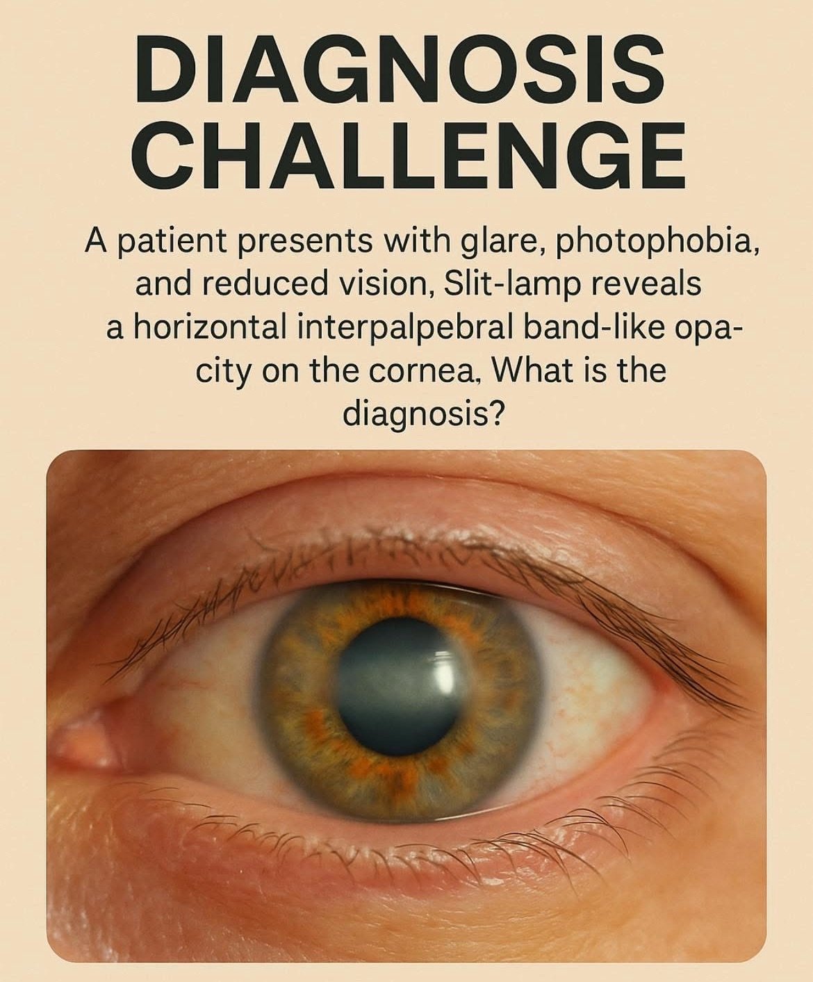 What is Calcific Band Keratopathy? 1 img 8775