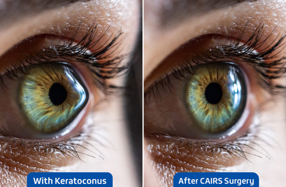 What is CAIRS Keratoplasty? 1 CAIRS Keratoplasty
